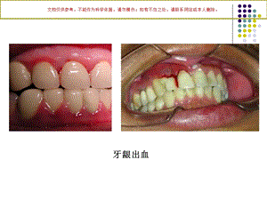 牙周疾病专题培训培训ppt课件.ppt