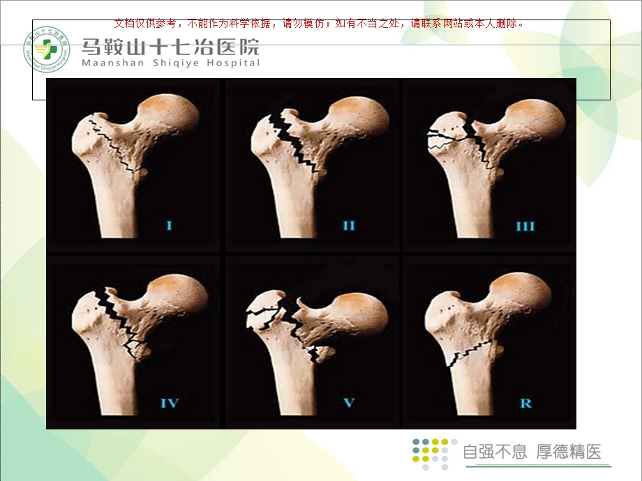 股骨粗隆间骨折术后护理查房ppt课件.ppt_第3页