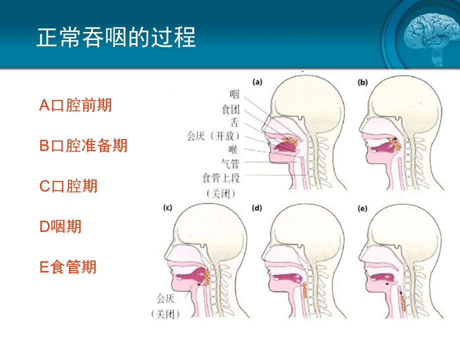 脑卒中吞咽障碍课件.ppt_第1页