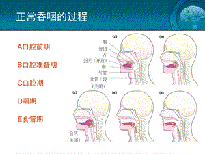 脑卒中吞咽障碍课件.ppt