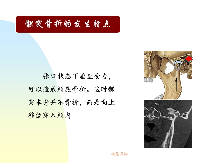 第四节髁突骨折课件.ppt_第3页