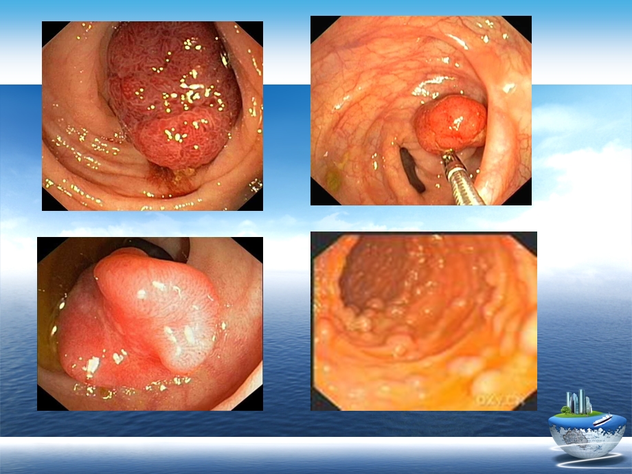 胃息肉的护理演示文稿课件.ppt_第3页