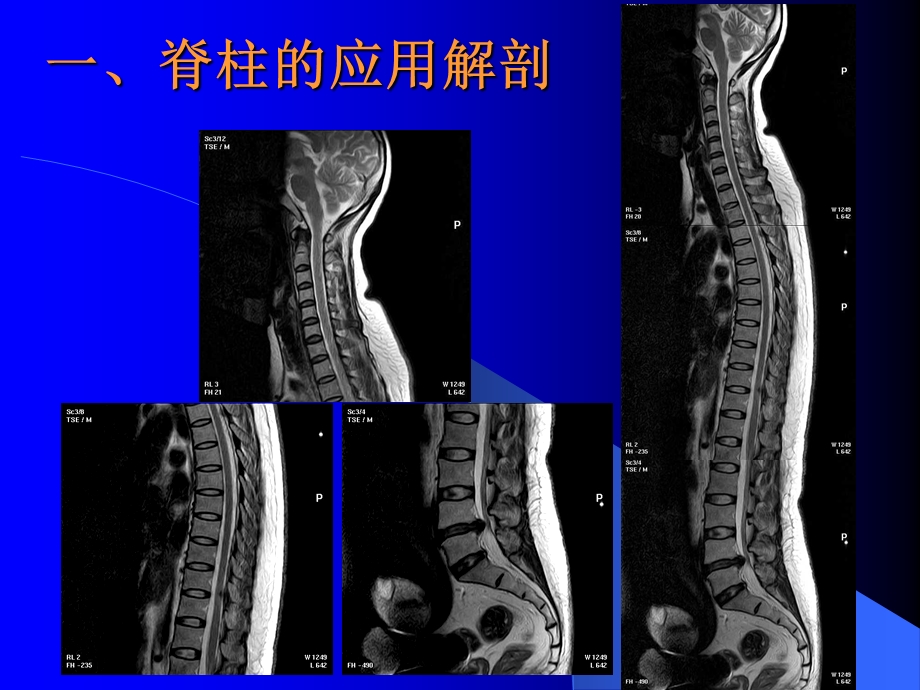 脊柱CT扫描技术讲解课件.ppt_第2页