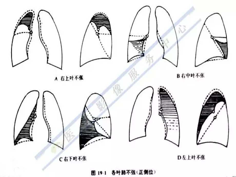 肺膨胀不全医学知识ppt课件.ppt_第3页