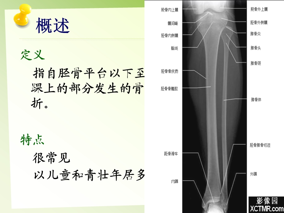 胫腓骨骨折的护理课件.ppt_第2页