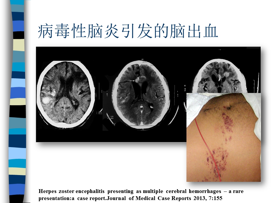 病毒性脑炎诊疗的困惑讲义课件.ppt_第3页