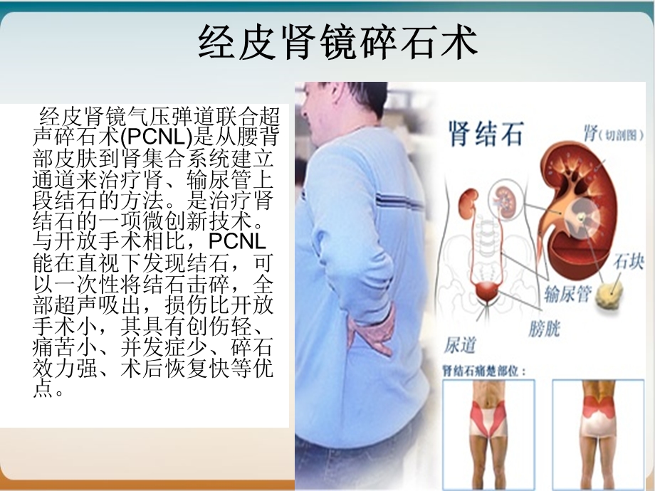 经皮肾镜手术配合优质ppt课件.ppt_第3页