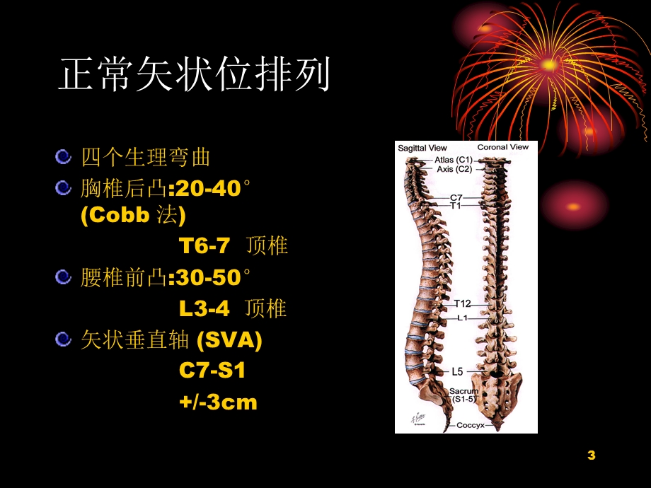 脊柱后凸课件.ppt_第3页