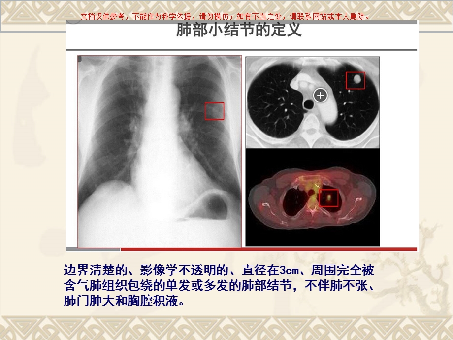 肺部小结节的处理策略ppt课件.ppt_第3页