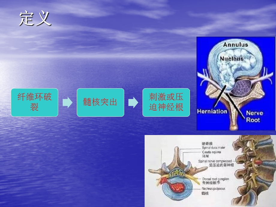 腰椎间盘突出症的诊治与预防PPT讲稿课件.ppt_第3页