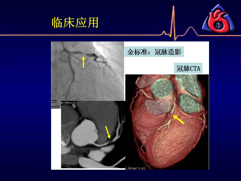 冠脉CTA读片(非常经典)课件.ppt_第2页