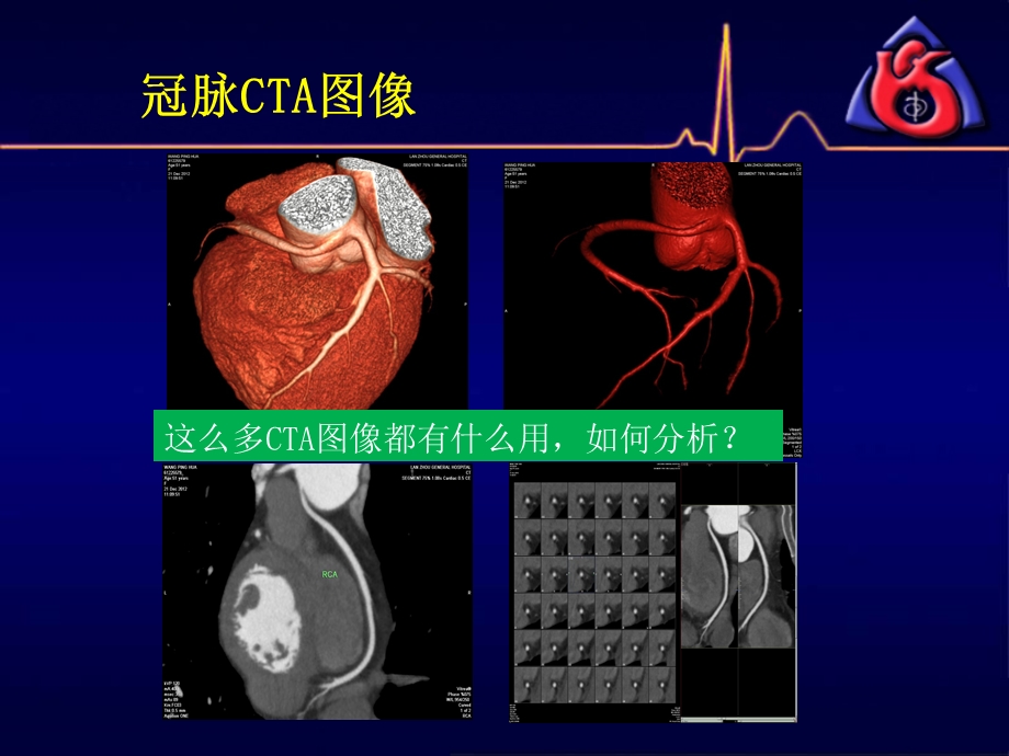 冠脉CTA读片(非常经典)课件.ppt_第3页