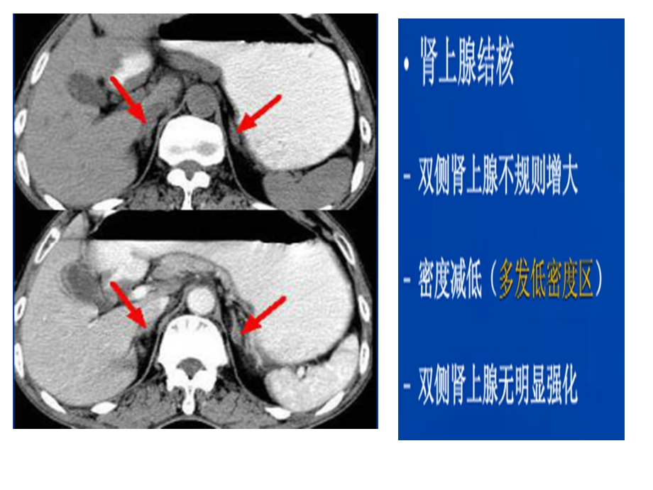 肾上腺结核的鉴别诊断课件.ppt_第3页