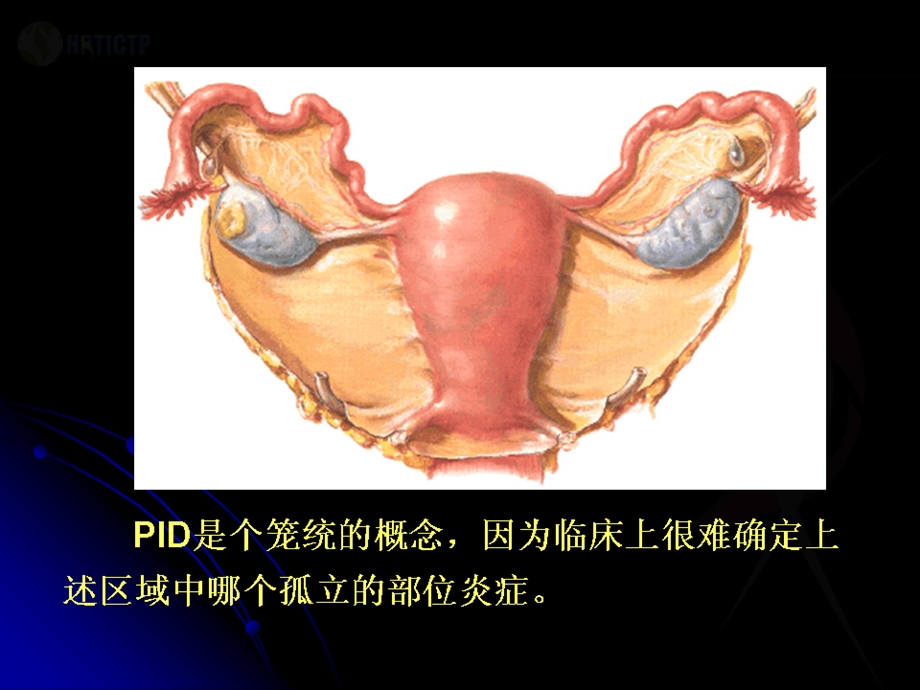 盆腔炎性疾病诊治新规范课件.ppt_第2页