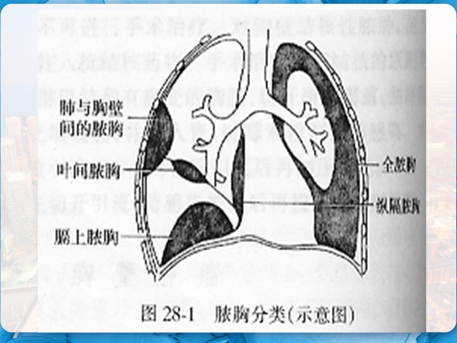 脓胸肺部感染外科治疗病人的护理课件.pptx_第3页