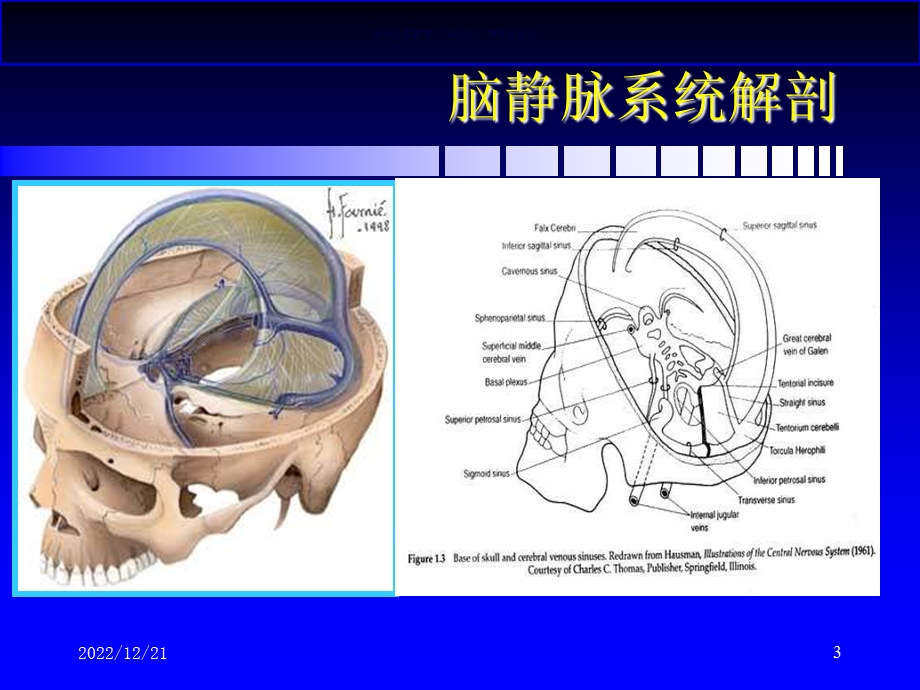 脑静脉和静脉窦血栓形成进展课件.ppt_第3页