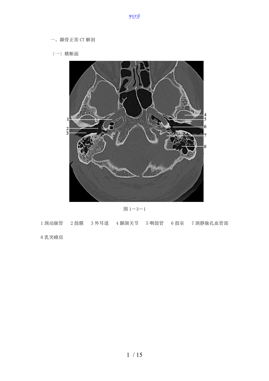 颞骨正常CT解剖附图.doc_第1页