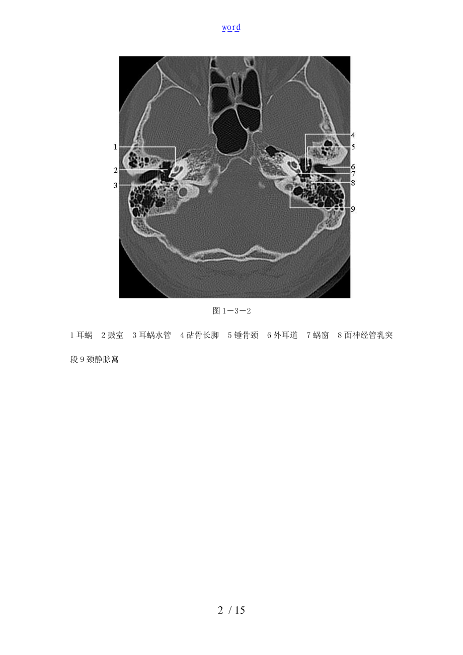 颞骨正常CT解剖附图.doc_第2页