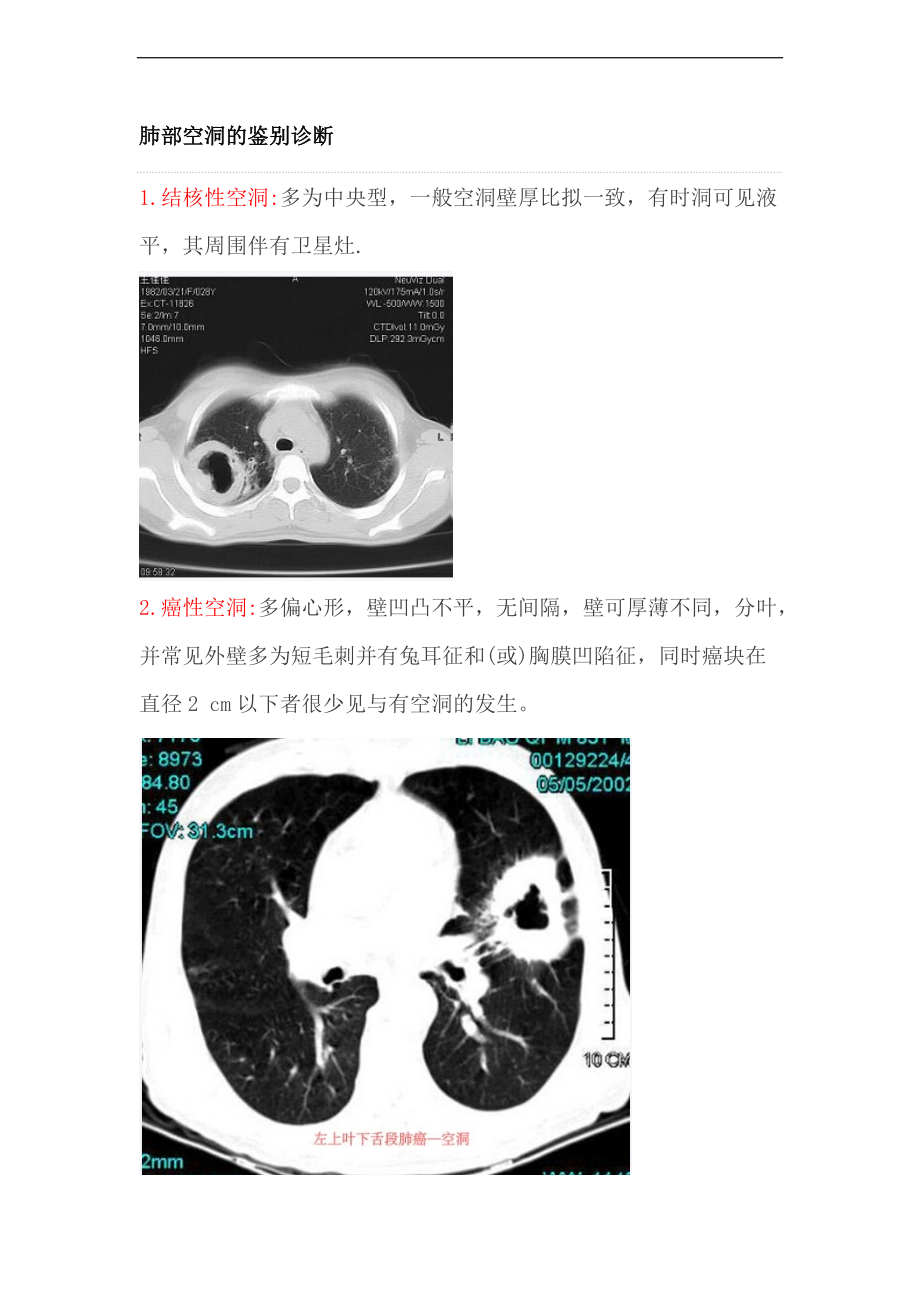 肺部空洞的鉴别诊断.doc_第1页