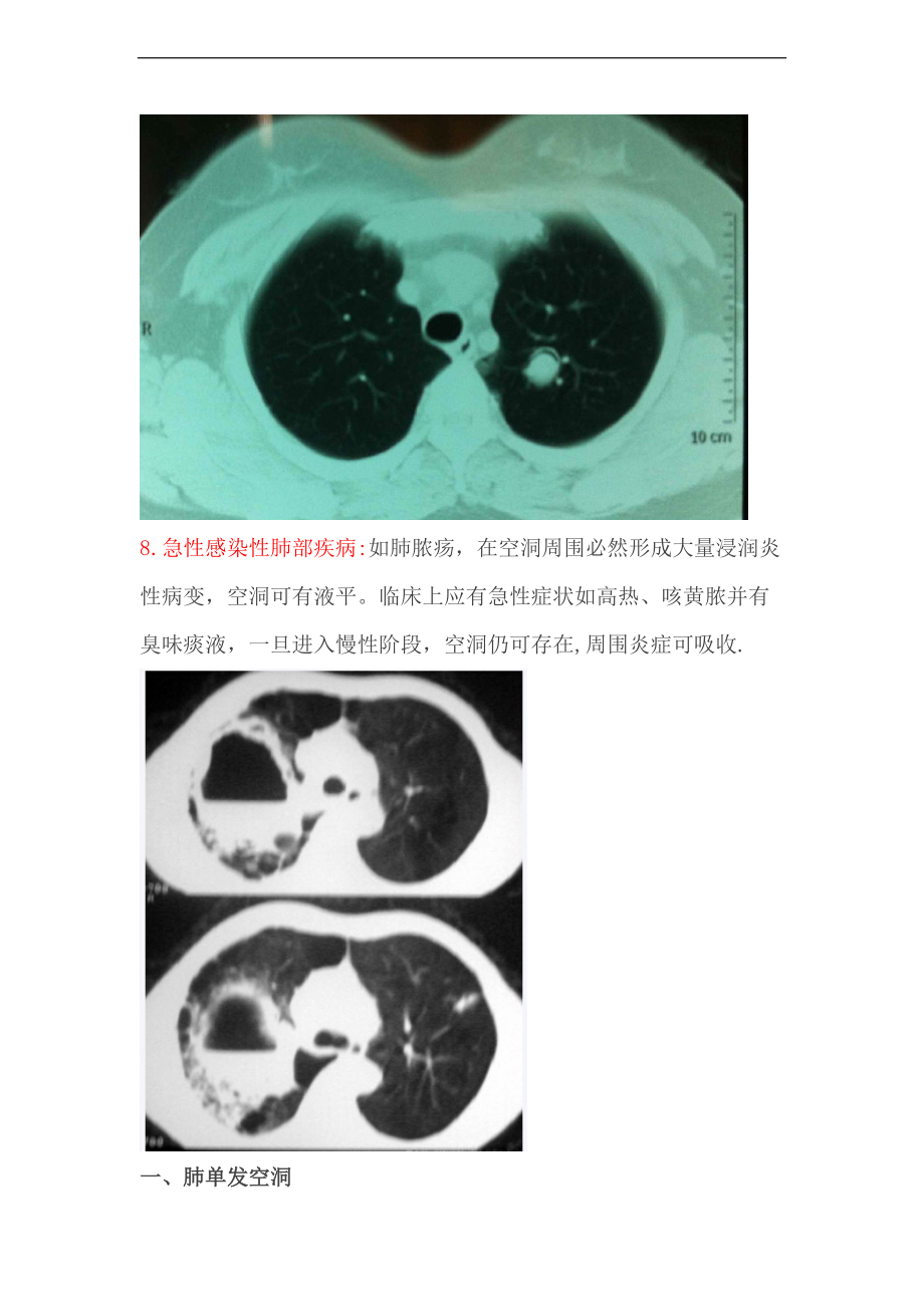 肺部空洞的鉴别诊断.doc_第3页