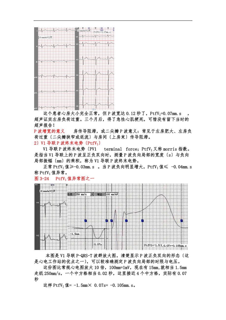 另类心电图学讲义4-P波时限与电压.doc_第3页