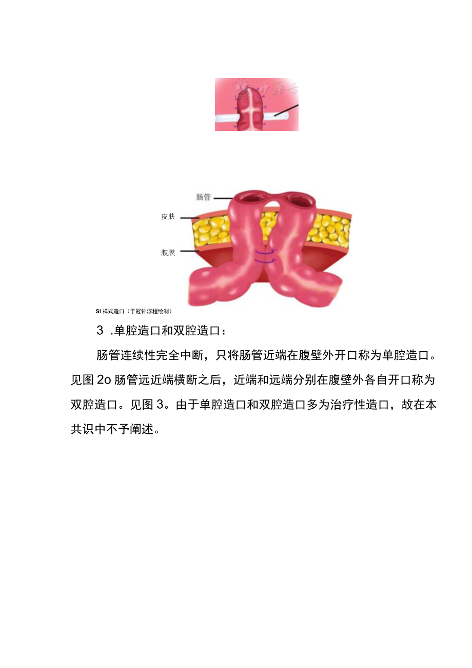 中低位直肠癌手术预防性肠造口中国专家共识（2022版）.docx_第3页