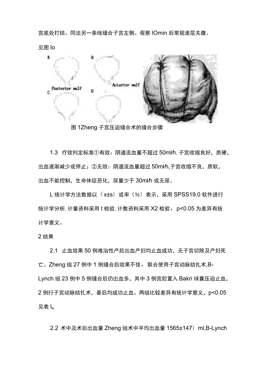 最新：Zheng子宫压迫缝合术救治产后出血的应用（全文）.docx_第3页