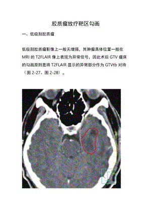 胶质瘤放疗靶区勾画.docx