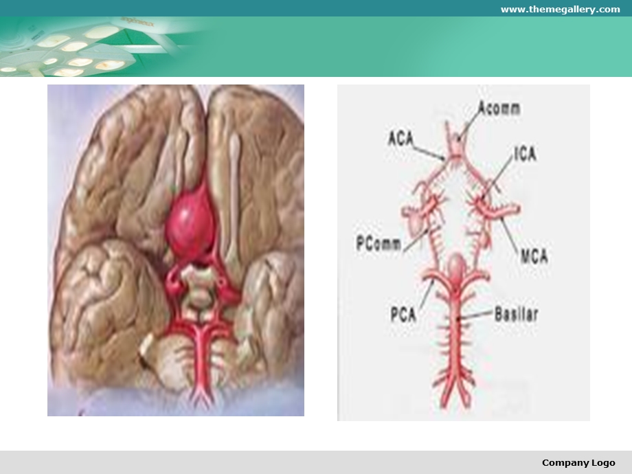 颅内动脉瘤的手术治疗.ppt_第3页