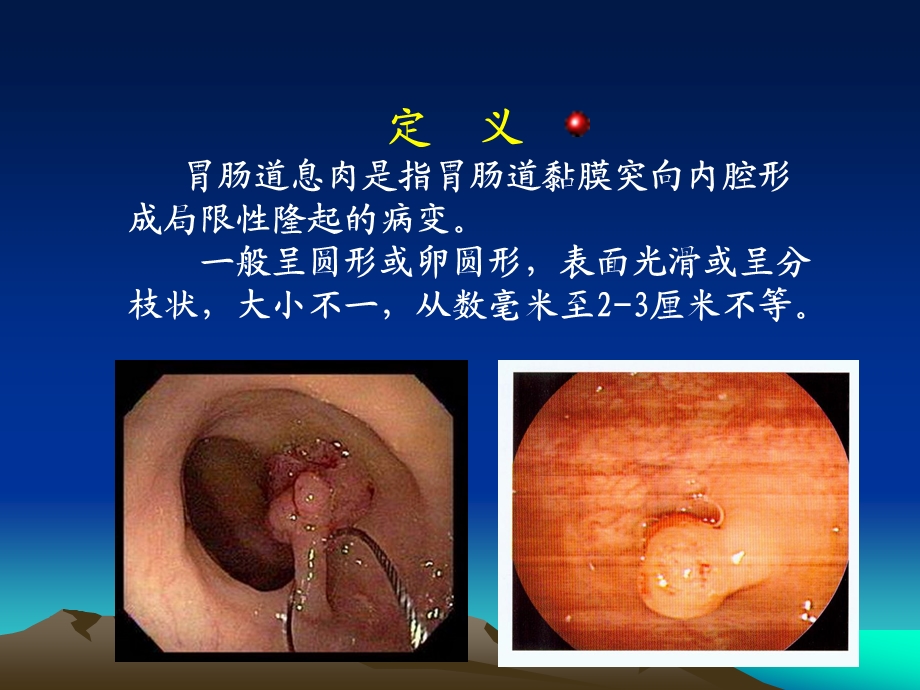 胃肠道息肉内镜下电凝切除术.ppt_第2页