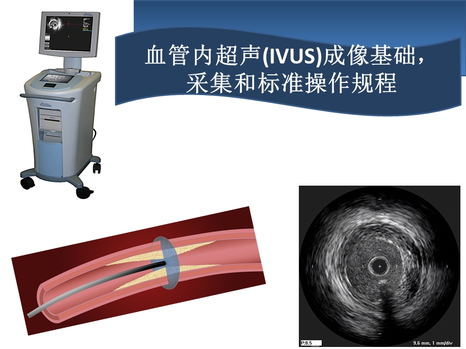 血管内超声IVUS简介.ppt_第1页