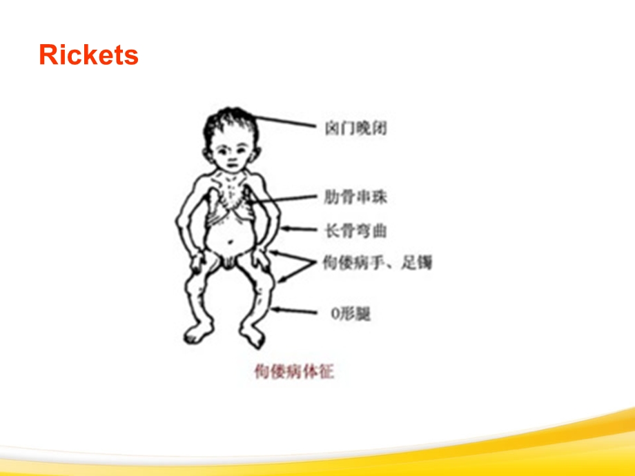 佝偻病与手足搐搦.ppt_第3页