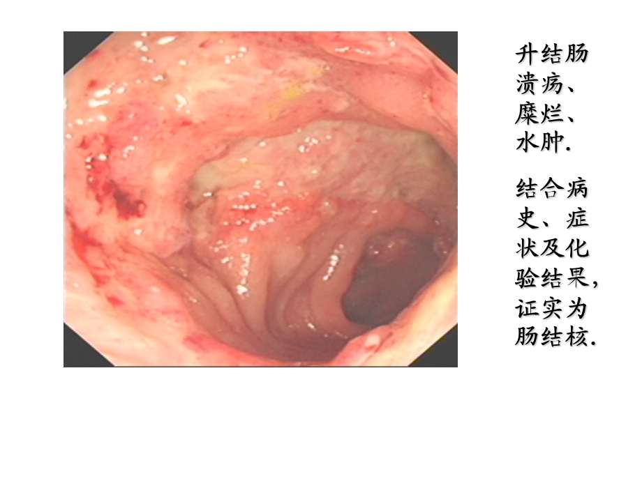 腹部结核.ppt_第3页