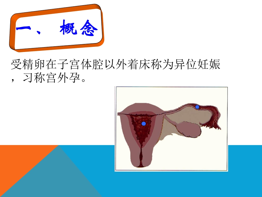 异位妊娠1.ppt_第2页