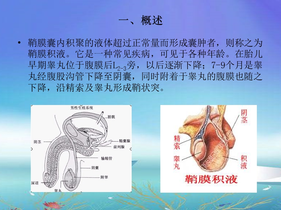 鞘膜积液业务学习学习总结总结汇报实用文档.ppt_第2页