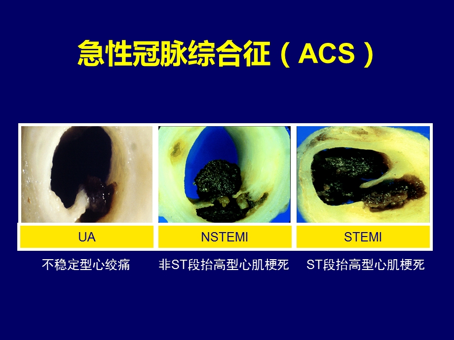 ACS危险分层及抗血小板优化治疗解读.ppt_第2页