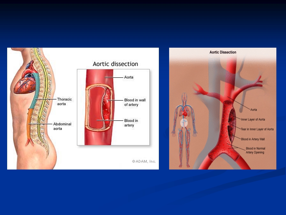 主动脉夹层动脉瘤【PPT】 .ppt_第3页