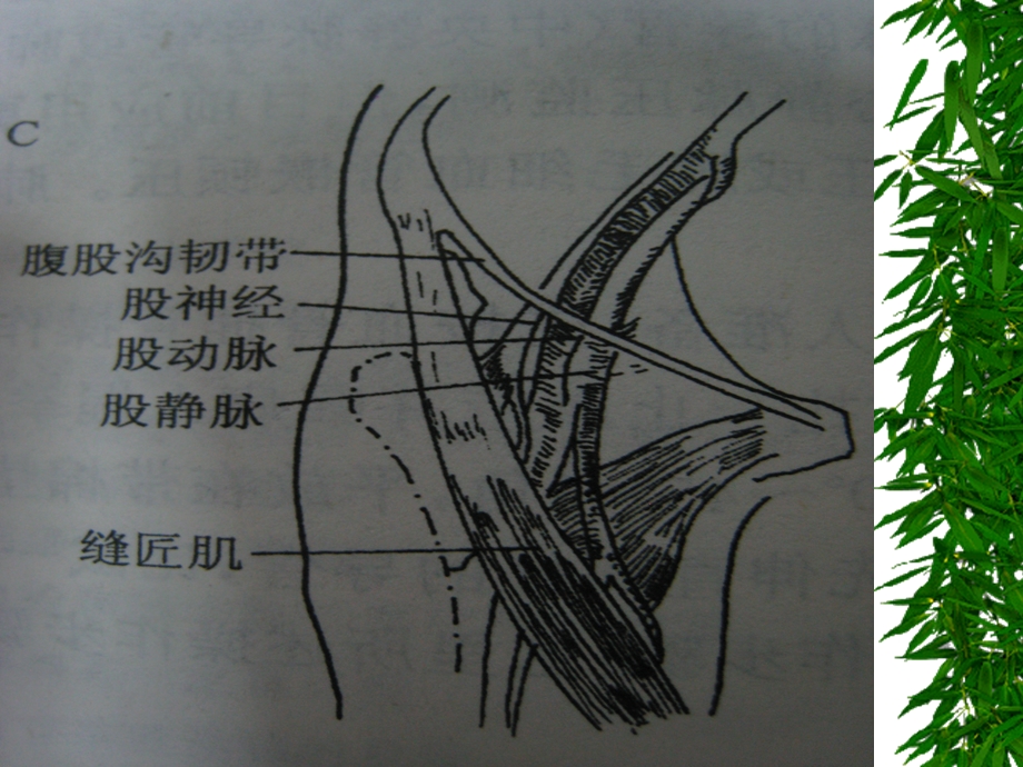 假性动脉瘤(PSEUDOANEURYSM.ppt_第3页