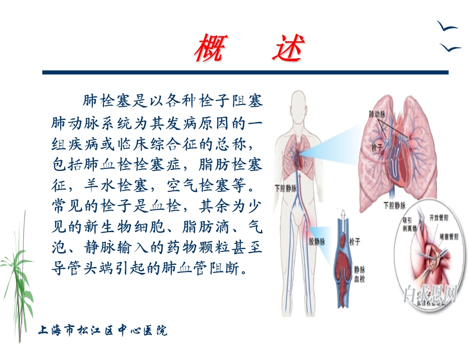 肺栓塞的治疗与护理.ppt_第2页