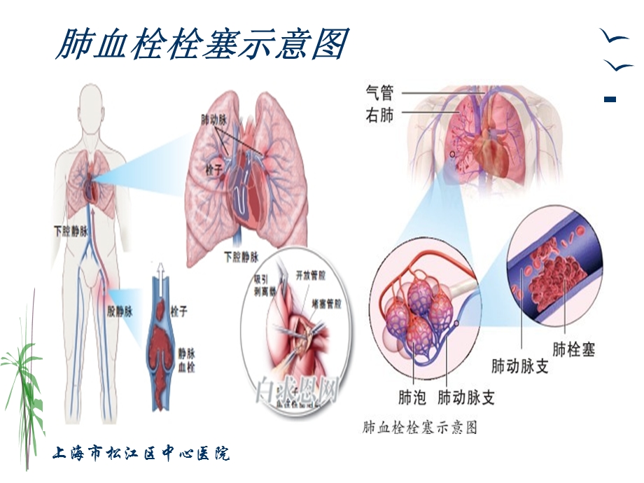 肺栓塞的治疗与护理.ppt_第3页