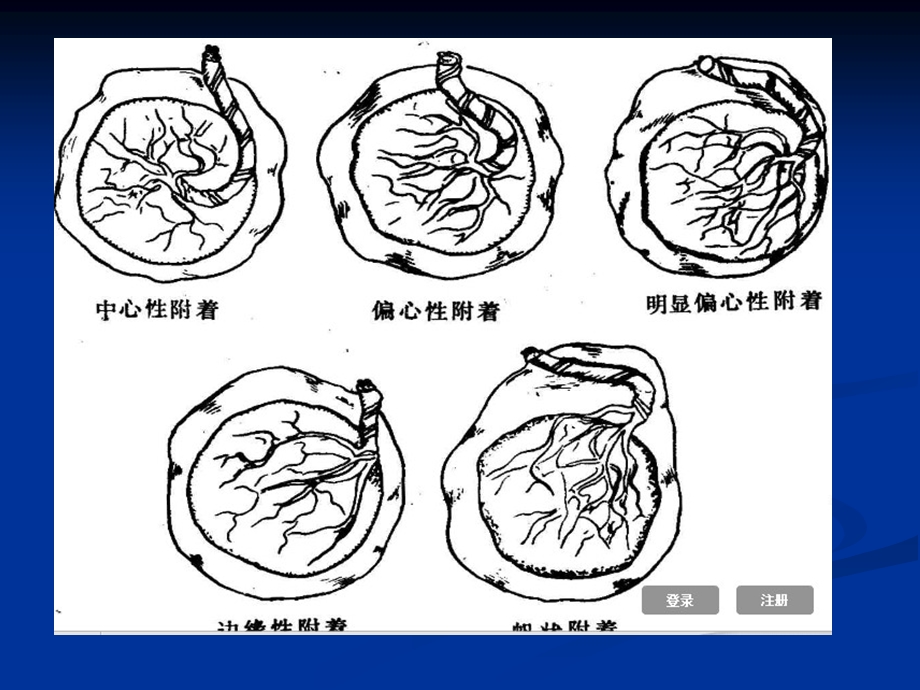 胎盘插入异常张小青.ppt_第3页