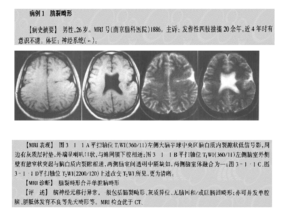 磁共振典型病例先天畸形ppt.ppt_第2页