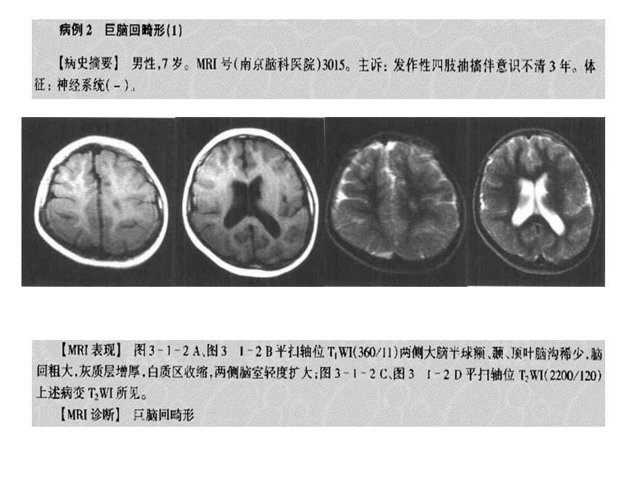 磁共振典型病例先天畸形ppt.ppt_第3页