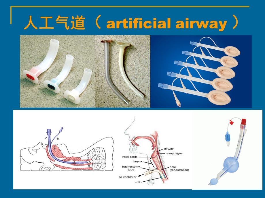 人工气道的建立与管理王淑芹——万人培训.ppt_第3页