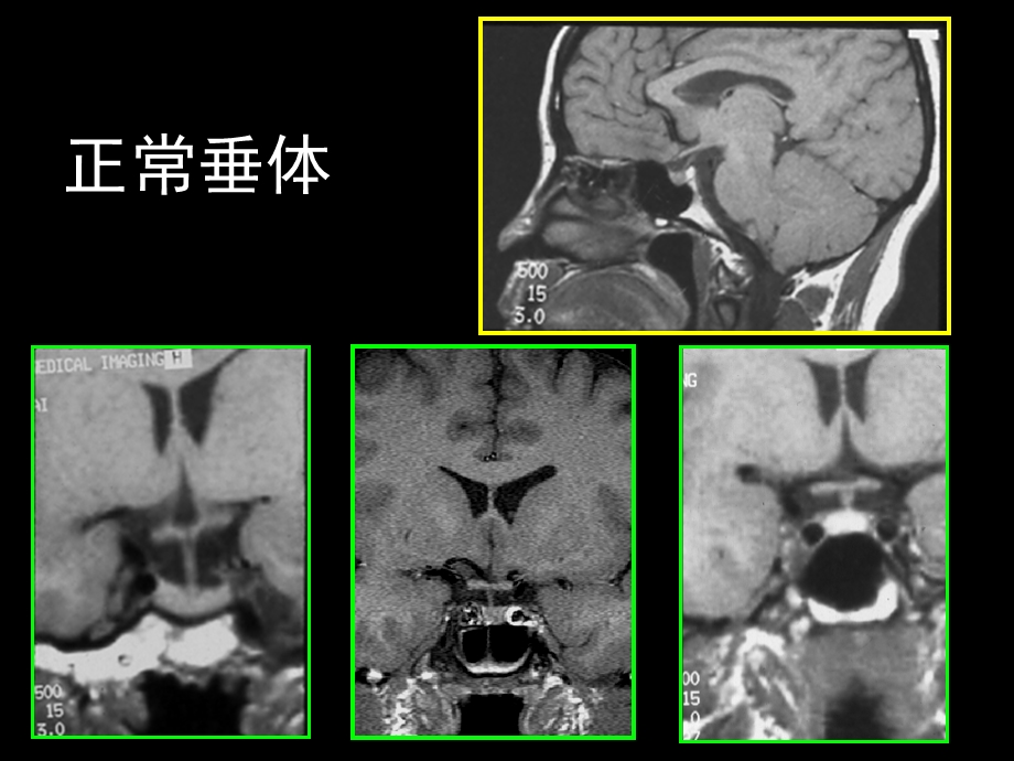 鞍区解剖及病变.ppt_第1页