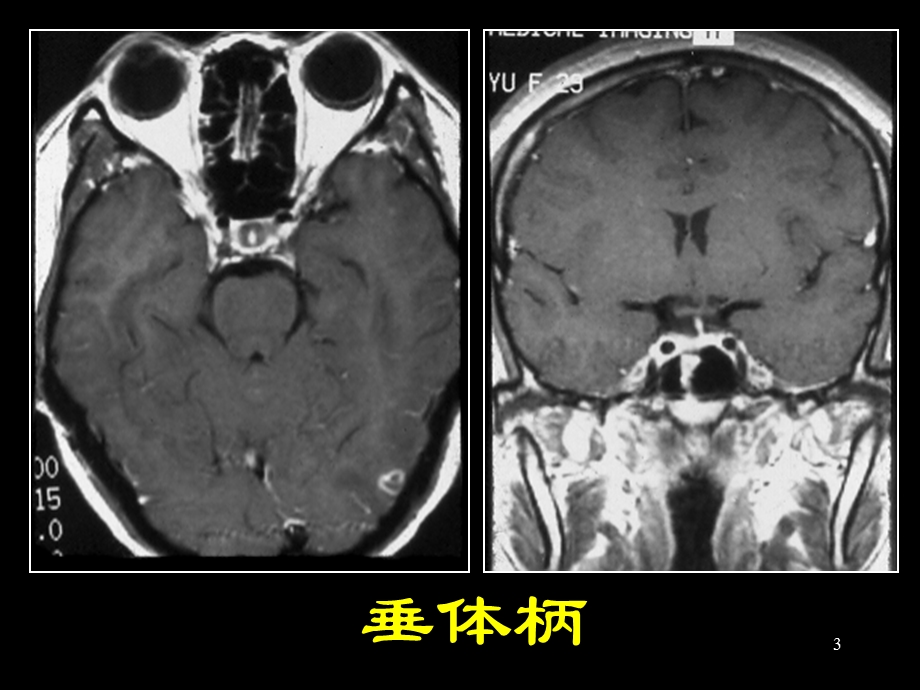 鞍区解剖及病变.ppt_第3页