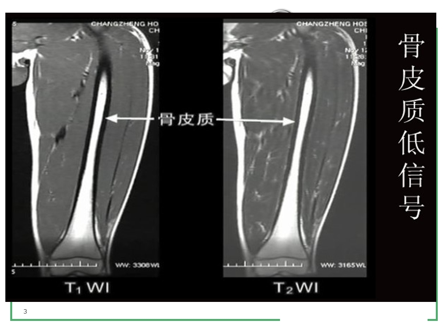 不同龄段骨髓MRI信号的差别.ppt_第3页