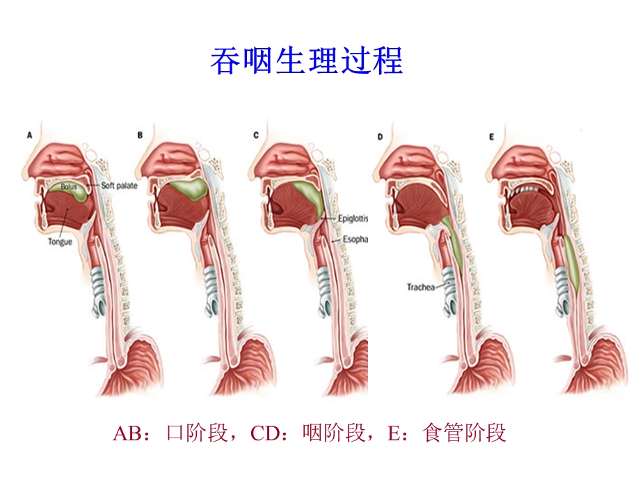 脑卒中后吞咽困难.ppt_第2页