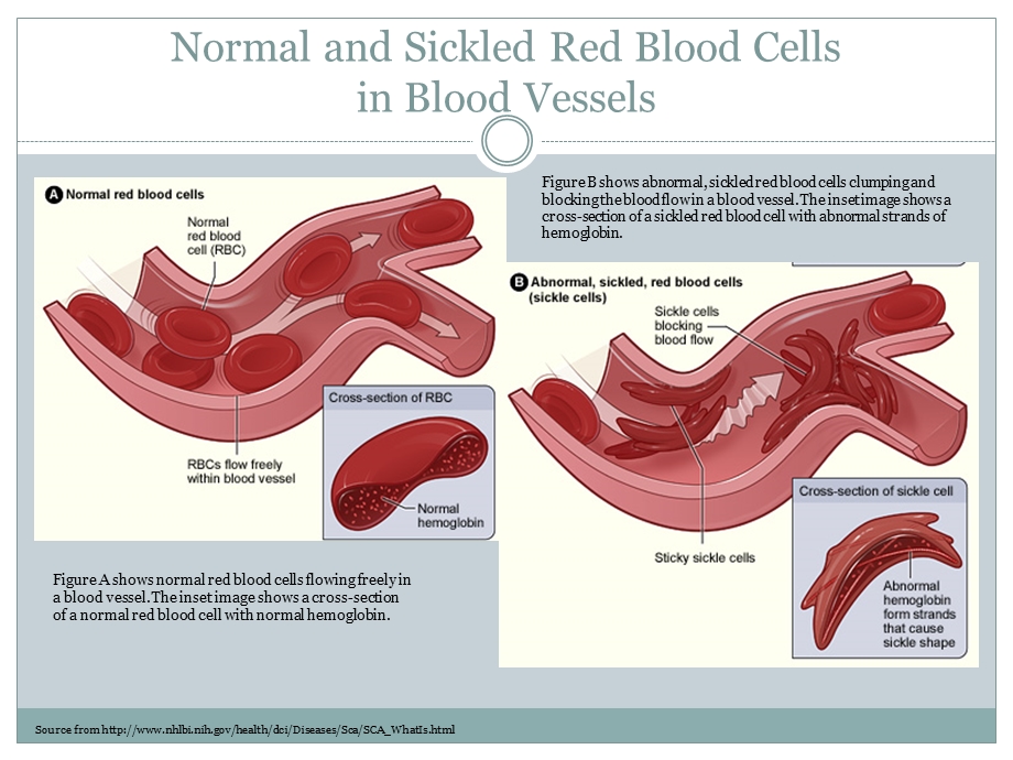 SICKLE CELL ANEMIA.ppt_第3页