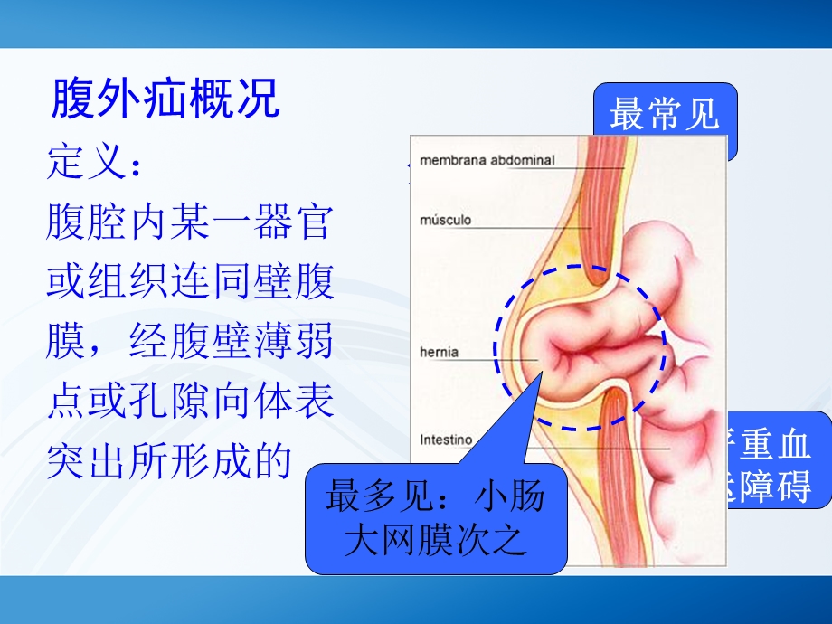 腹股沟疝护理.ppt_第3页